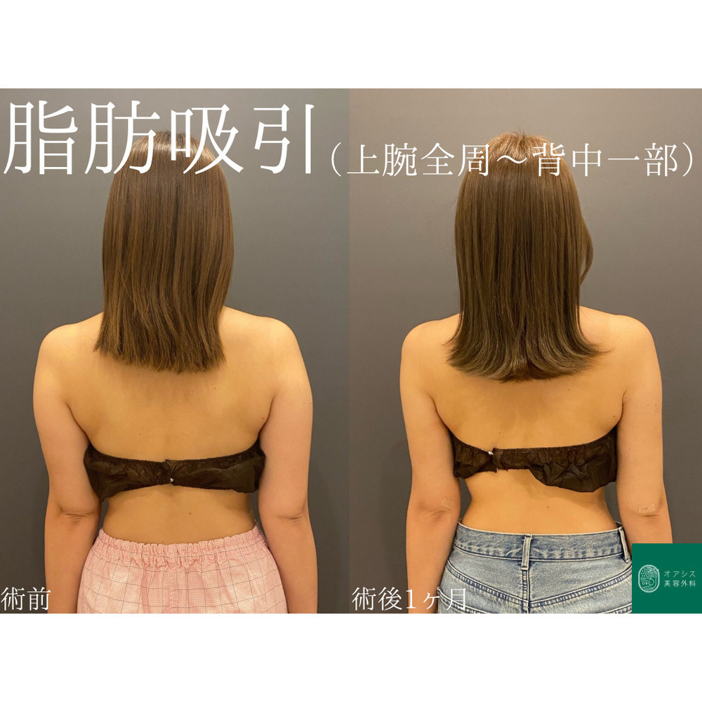 オアシス美容外科 🌴カリカリ腕を目指せる🌴コンプリート脂肪吸引【上腕全周〜お背中一部】