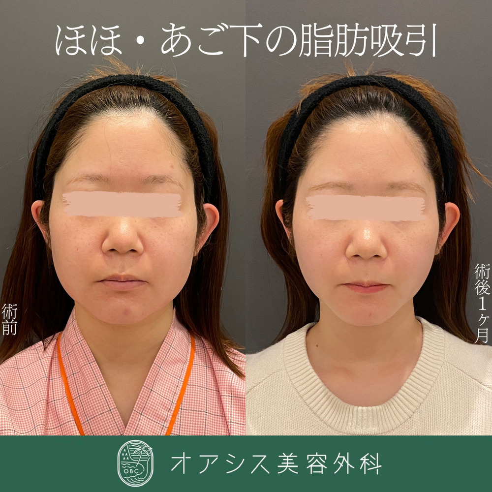 オアシス美容外科 フェイスライン形成🌴頬と顎下の脂肪吸引🌴形成外科専門医がご対応✨