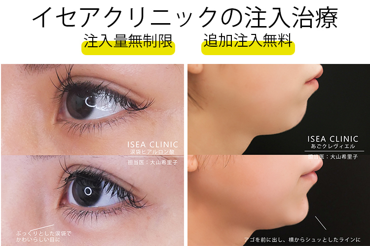 東京イセアクリニック 【注入量無制限】注入量を気にせず理想の形に近づける