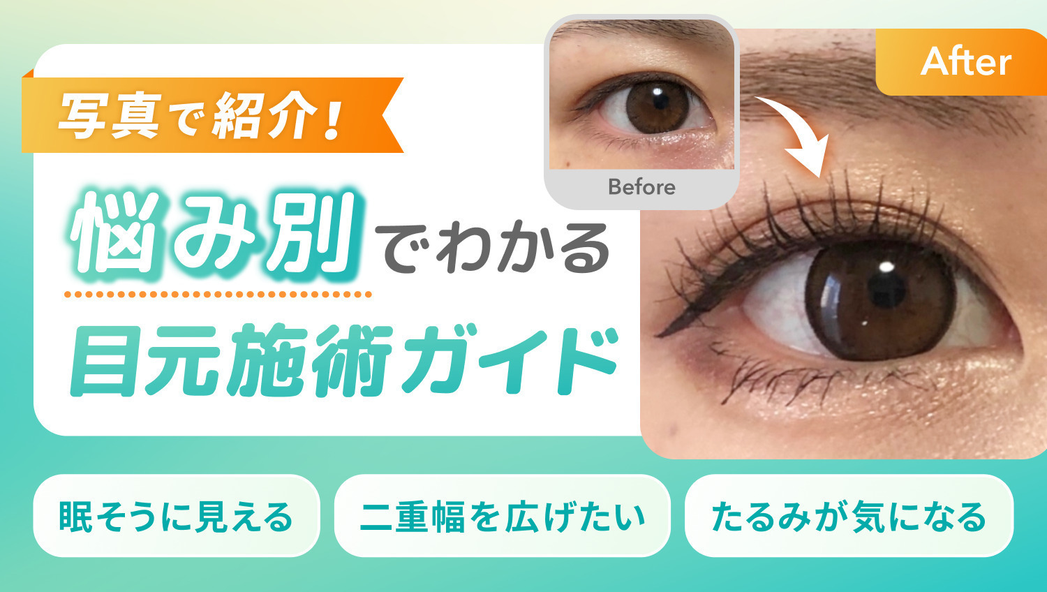 あなたにピッタリの二重術で愛されeyeになろう♡