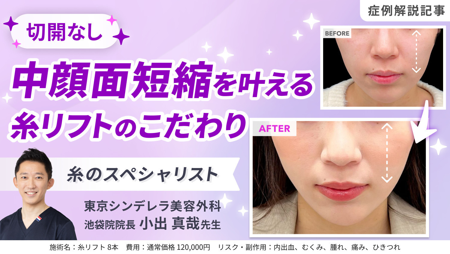 症例解説 小出先生｜中顔面短縮×リフトアップ！糸リフトで垢抜け♡