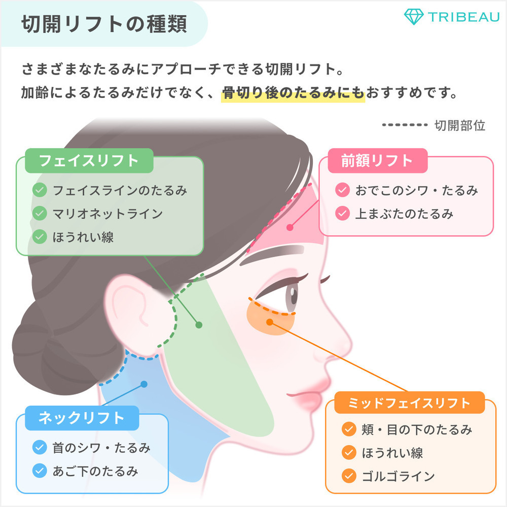 切開リフト 解説画像1 メイン用