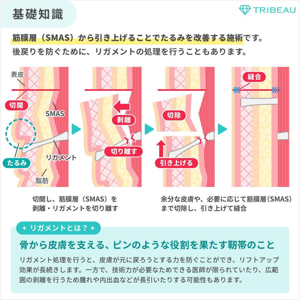 切開リフト 解説画像2 メイン用