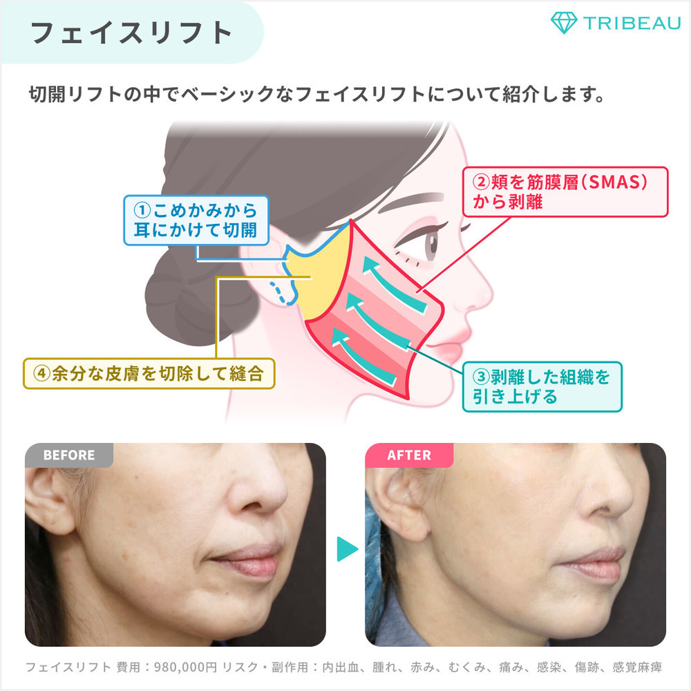 切開リフト 解説画像3 メイン用