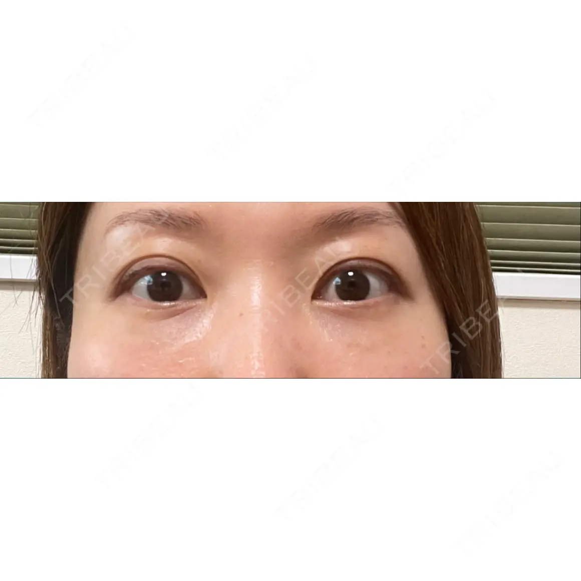 クマ治療 X CLINIC 銀座院 AFTER