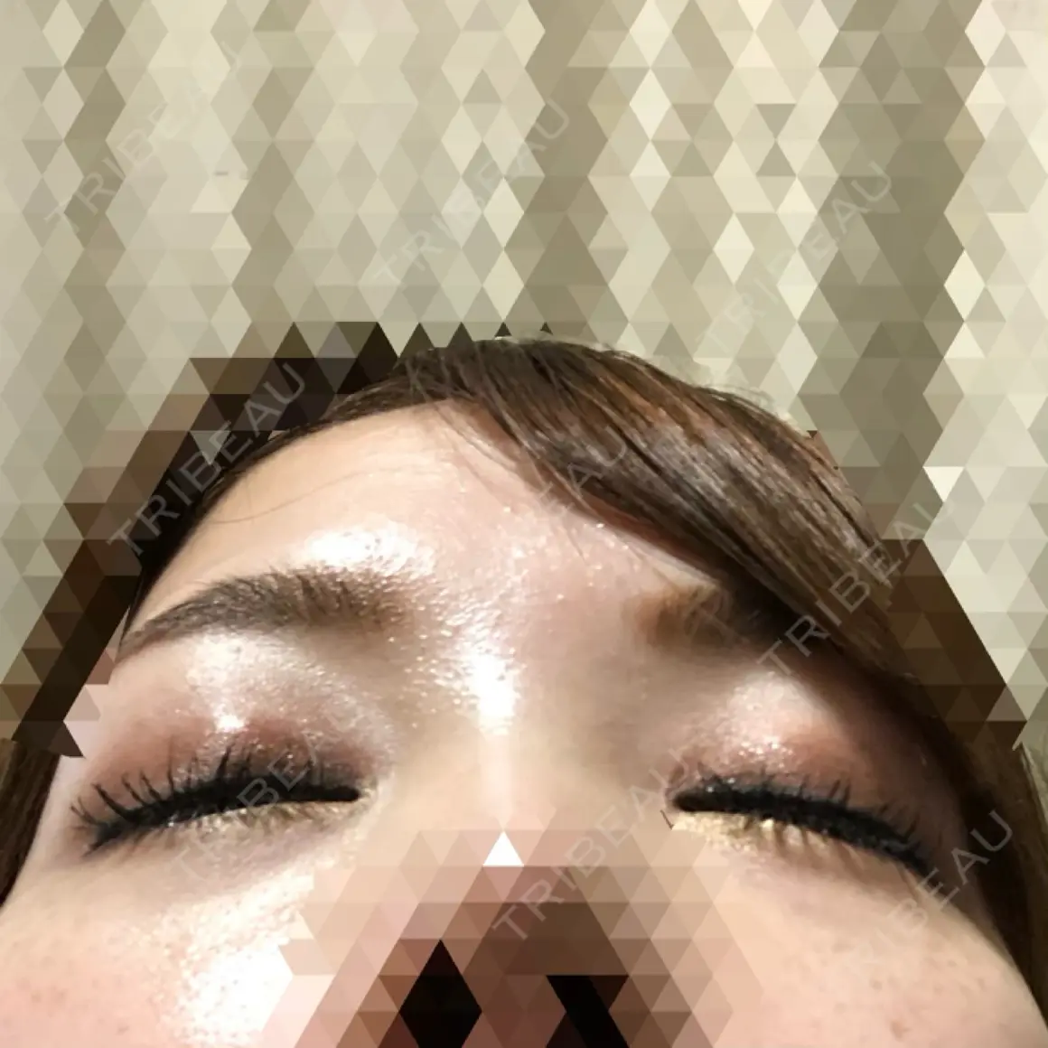 ヒアルロン酸注入（涙袋） / その他（目元） 渋谷美容外科クリニック 池袋院 AFTER