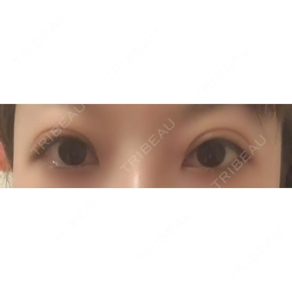 二重切開 / 眼瞼下垂（切開） みやび形成外科 AFTER