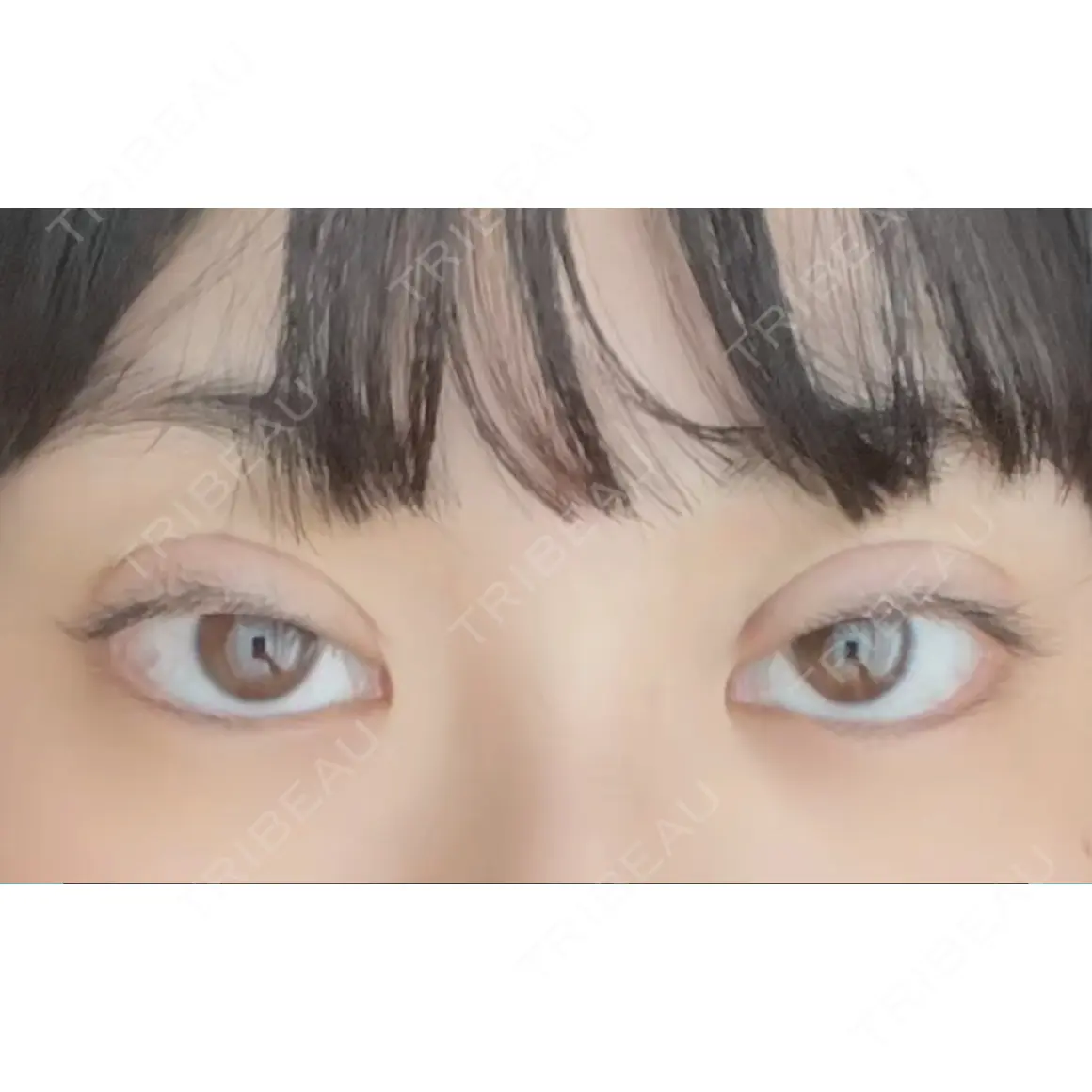 二重埋没 9BeautyClinic DAY 0