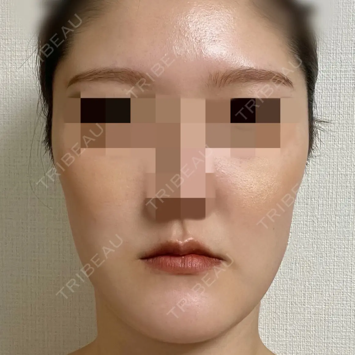 骨切り（あご） 銀座マイアミ美容外科 AFTER