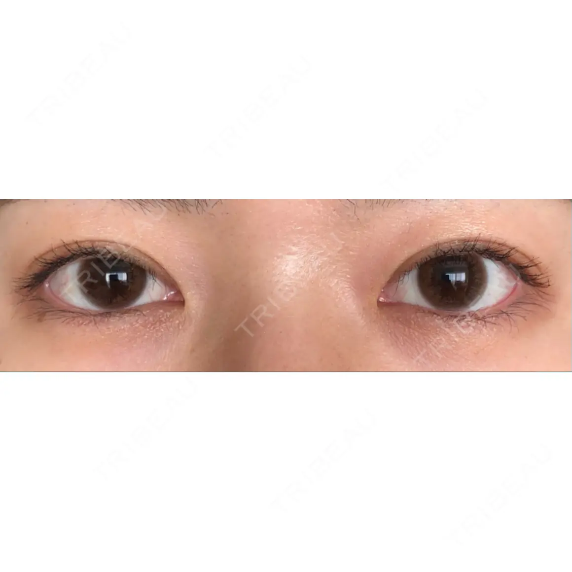 二重埋没 シンデレラ＆ダヴィンチクリニック AFTER