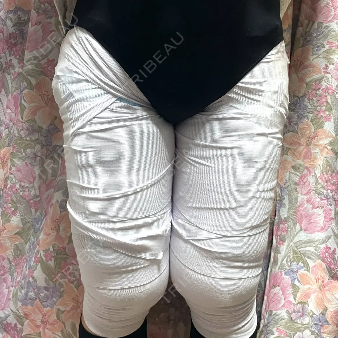 脂肪吸引（脚） 大阪雅美容外科 DAY 1
