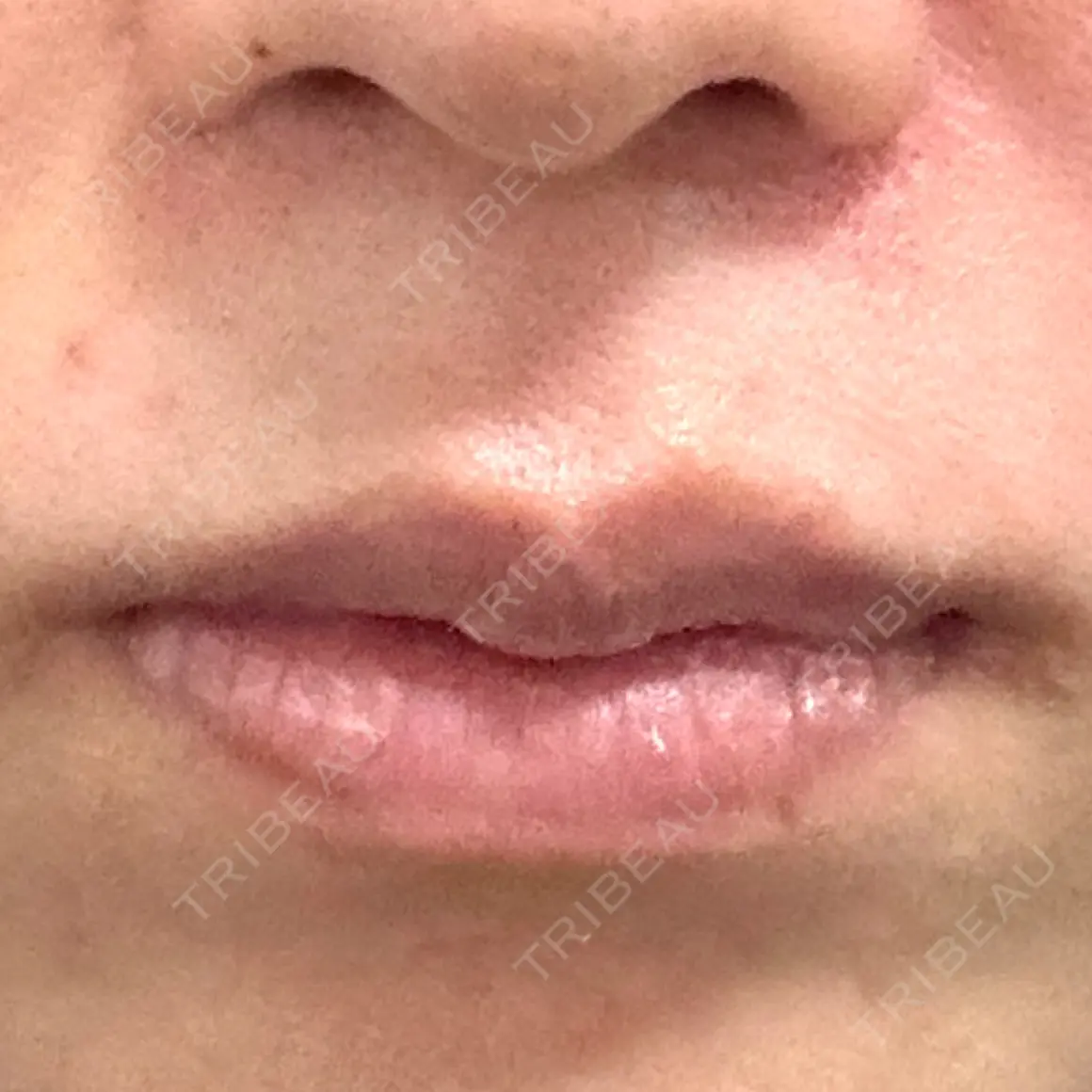 口唇縮小術 宇都宮竹内クリニック AFTER