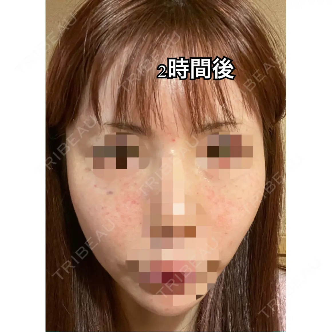 水光注射（ハリ・美肌） フィラークリニック 錦糸町院 DAY 0