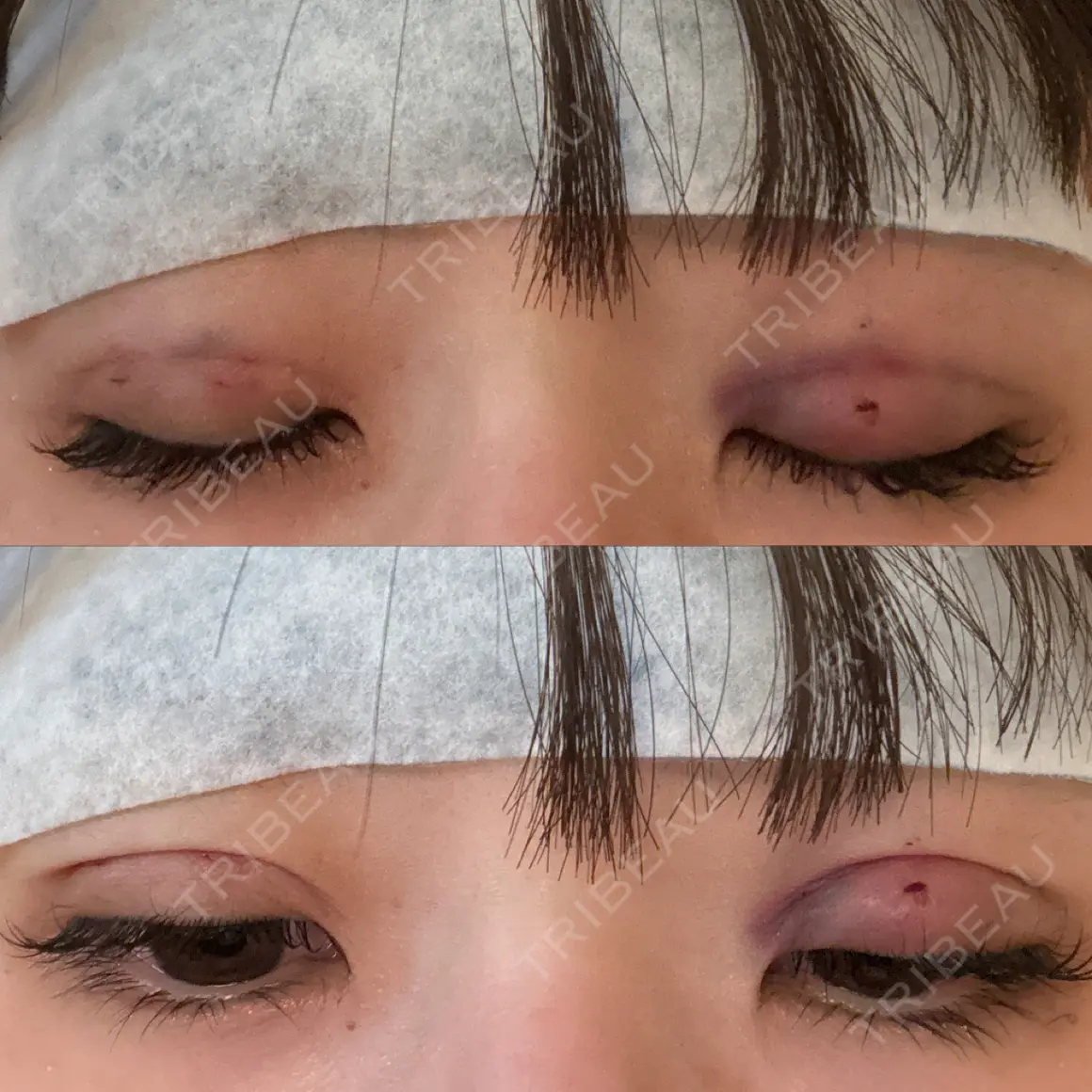 二重埋没 9BeautyClinic DAY 0