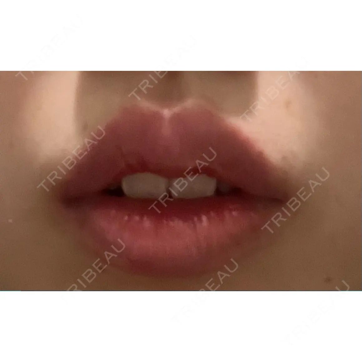ヒアルロン酸注入（唇） 橿原 BEAUTY CLINIC DAY 0