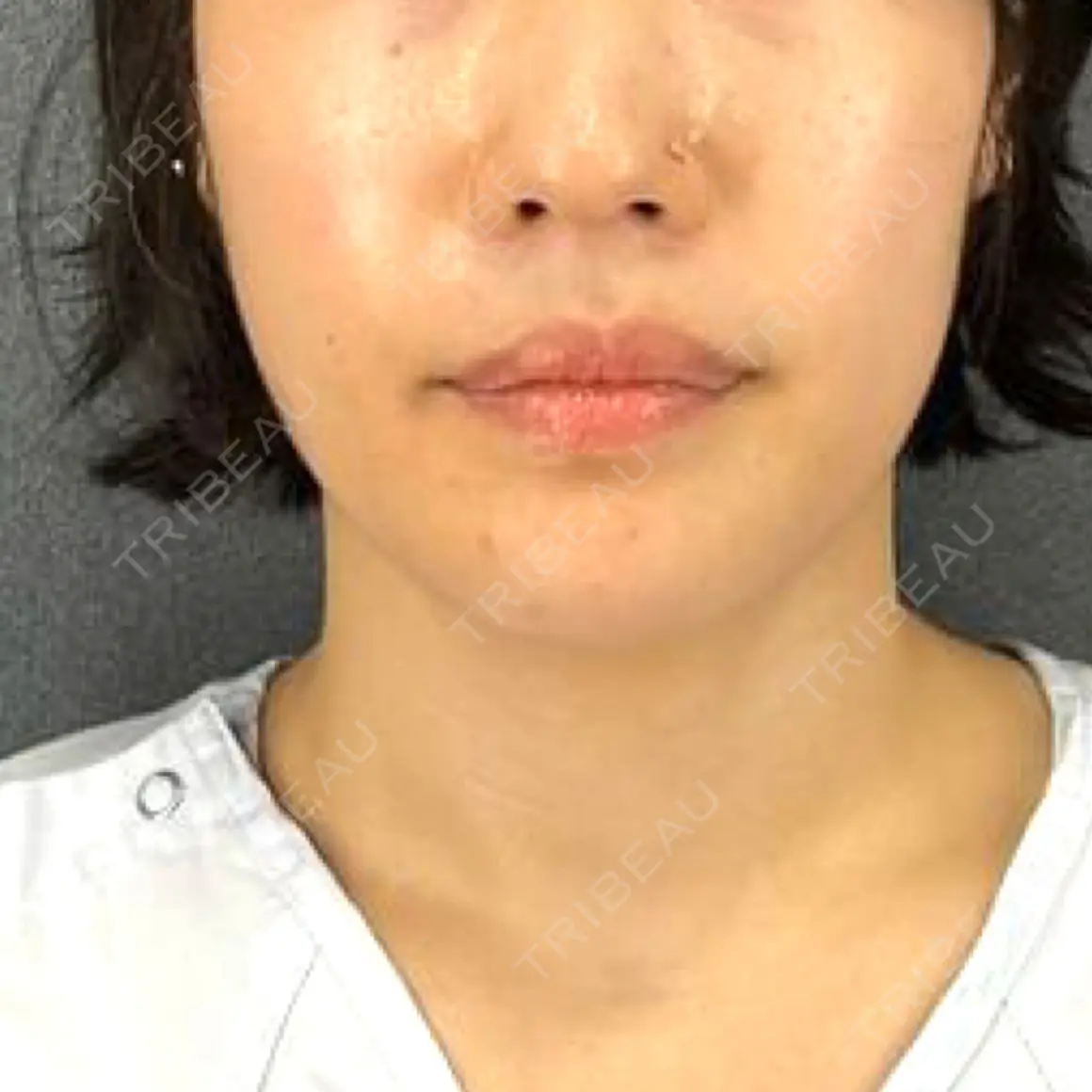 糸リフト / 脂肪吸引（顔） / ボトックス（エラ・小顔） X CLINIC 銀座院 AFTER