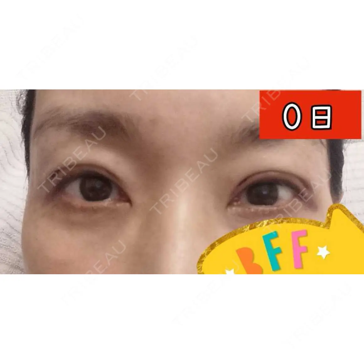 眼瞼下垂（切開） みやび形成外科 DAY 0