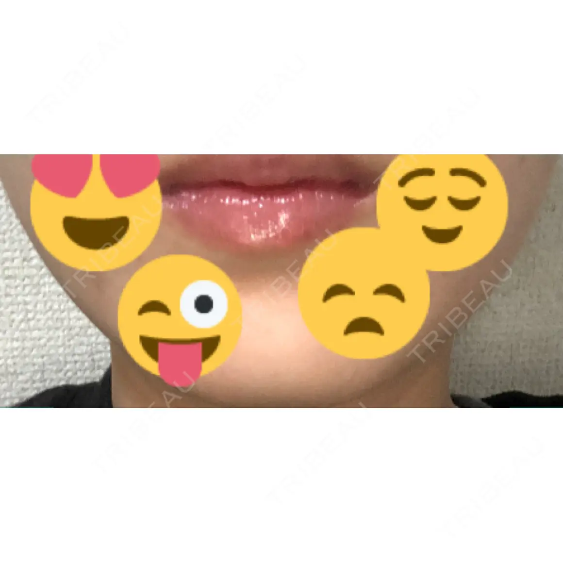 ボトックス（エラ・小顔） 川越TAクリニックアソシエ AFTER