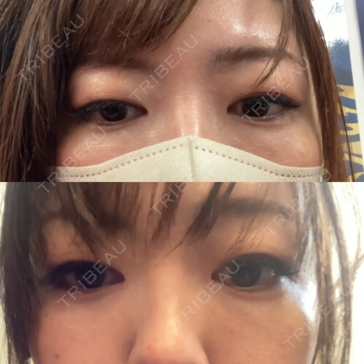クマ治療 X CLINIC 銀座院 AFTER