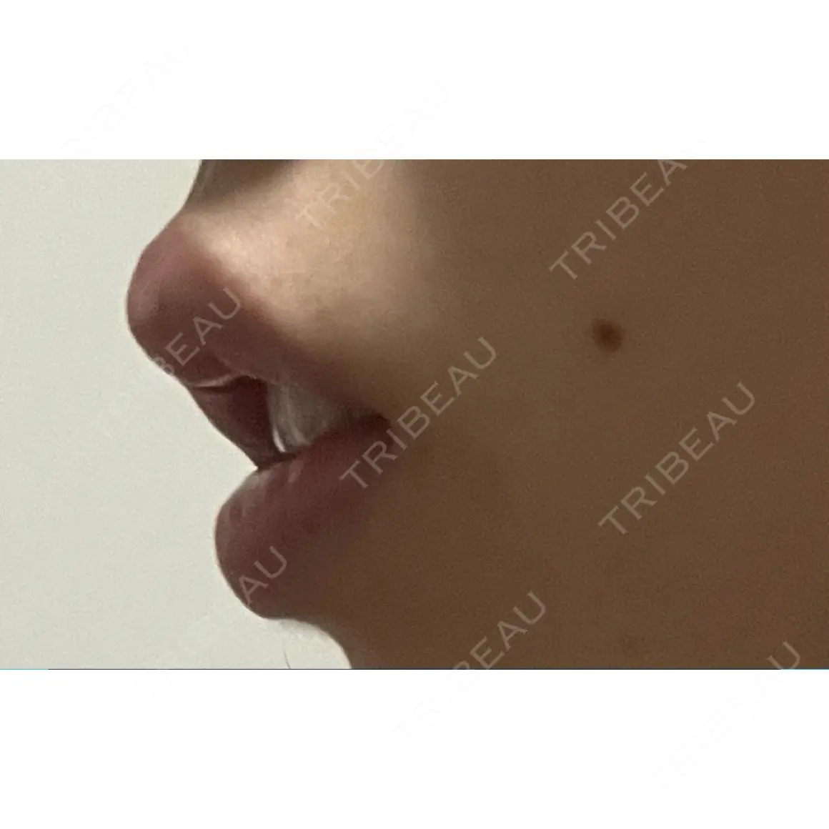 ヒアルロン酸注入（唇） 橿原 BEAUTY CLINIC AFTER