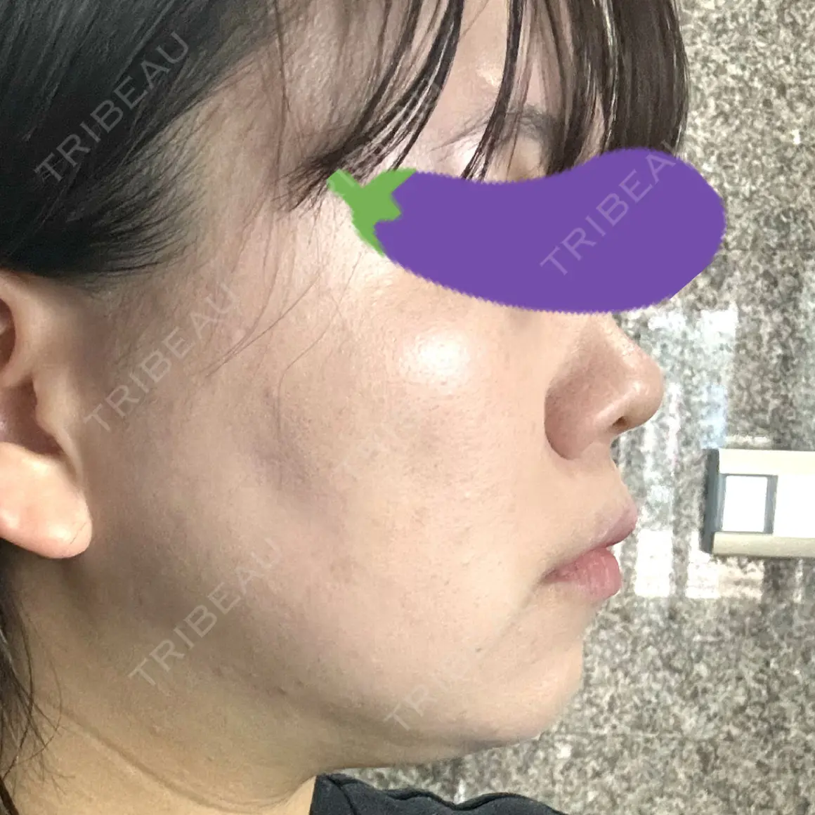 ハイフ（顔） 銀座TSUBAKIクリニック DAY 0