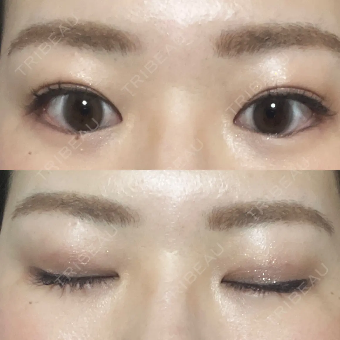 上まぶたの脂肪取り 9BeautyClinic AFTER