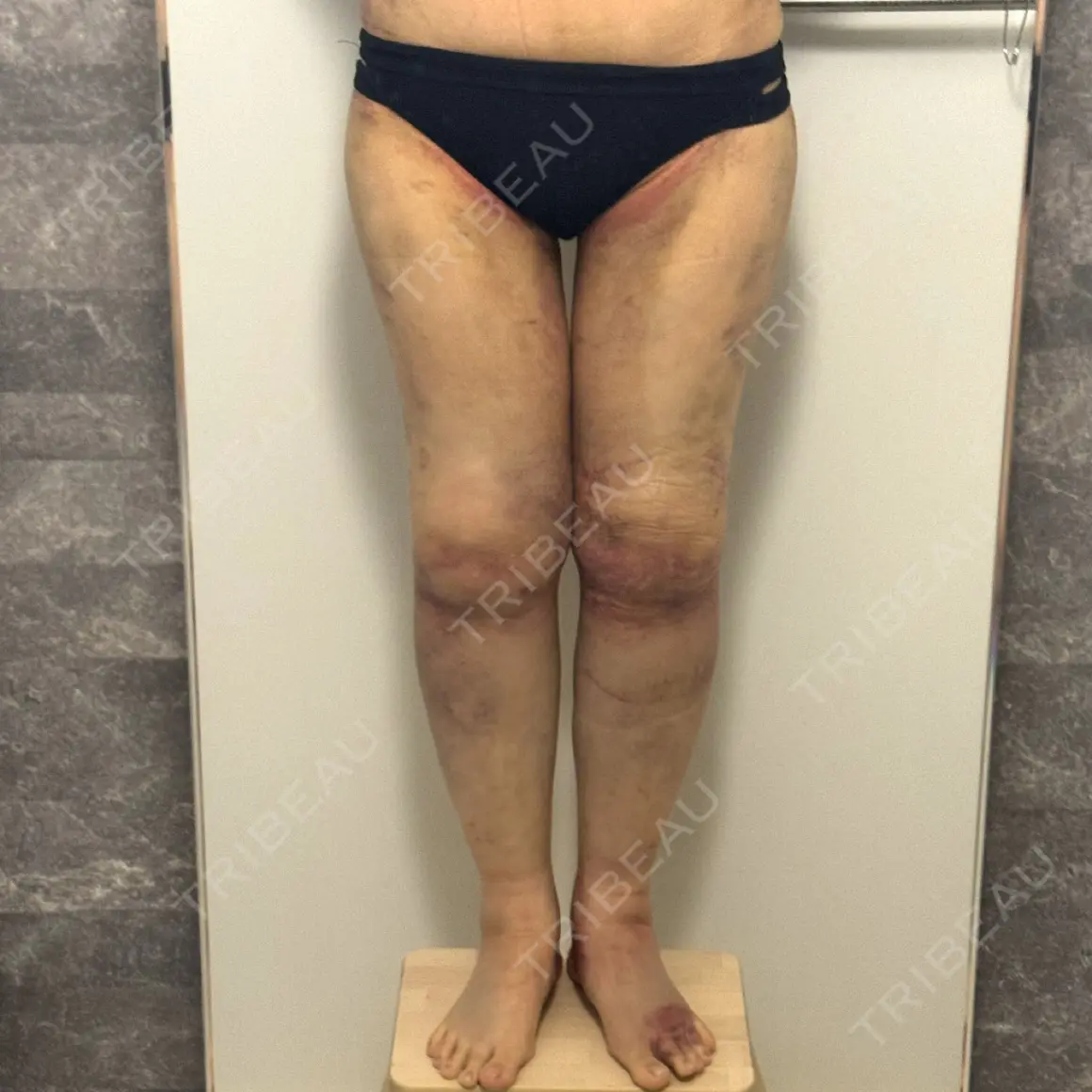 脂肪吸引（脚） 湘南美容クリニック 京都院 DAY 4