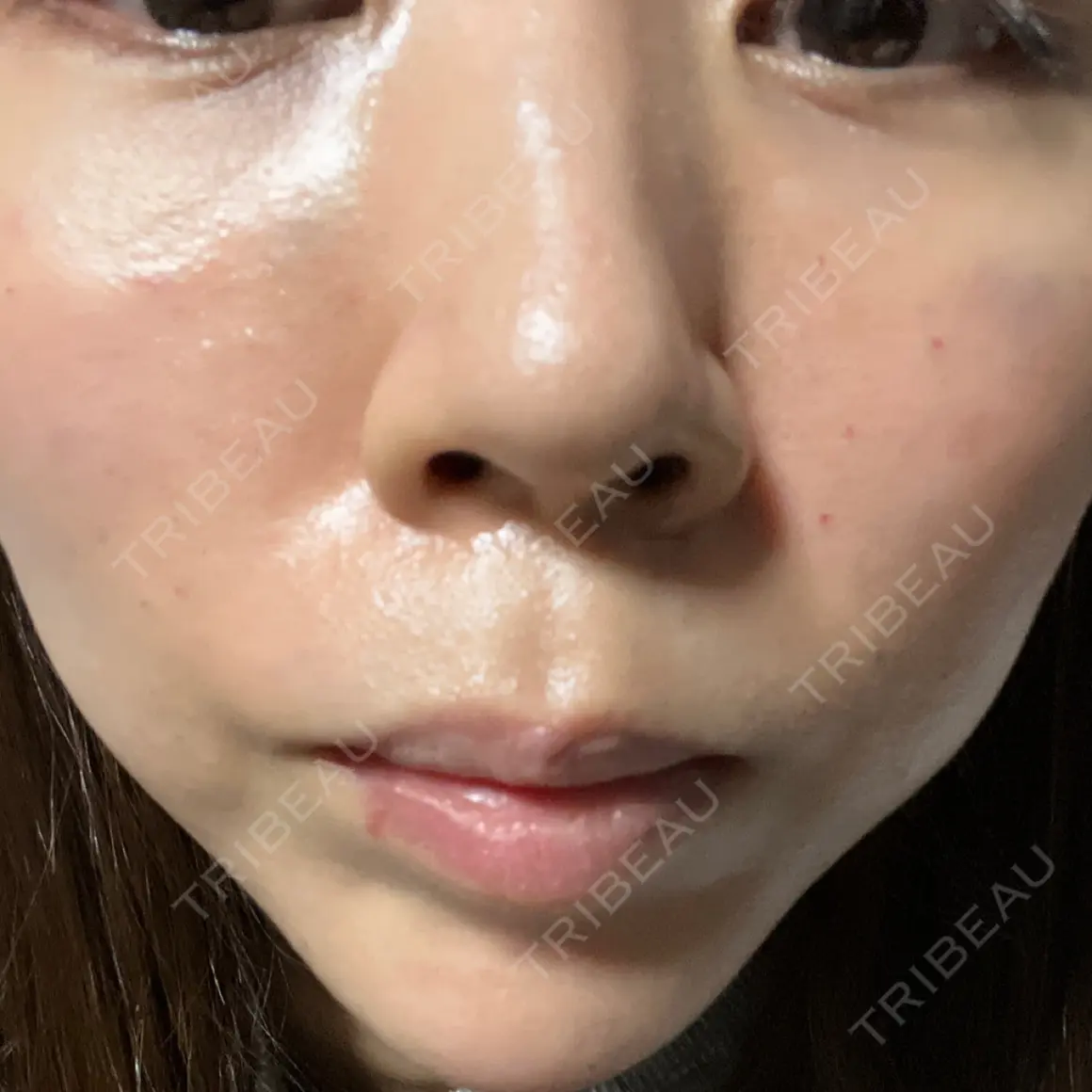 肌ヒアルロン酸注入（たるみ・シワ改善） BAO CLINIC 心斎橋院 DAY 0