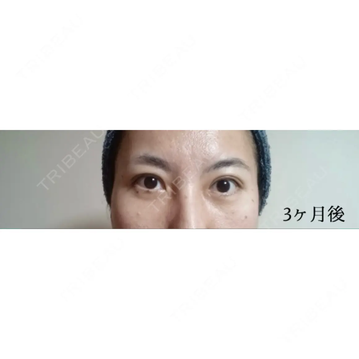 クマ治療 / 下まぶたたるみ取り 湘南美容クリニック 新宿本院 AFTER
