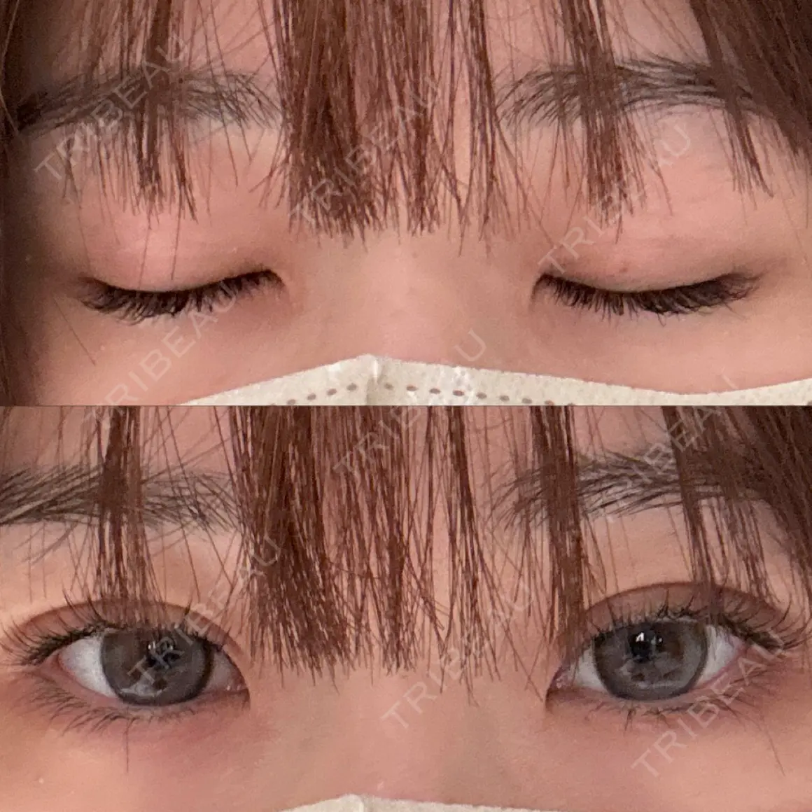 二重埋没 9BeautyClinic AFTER