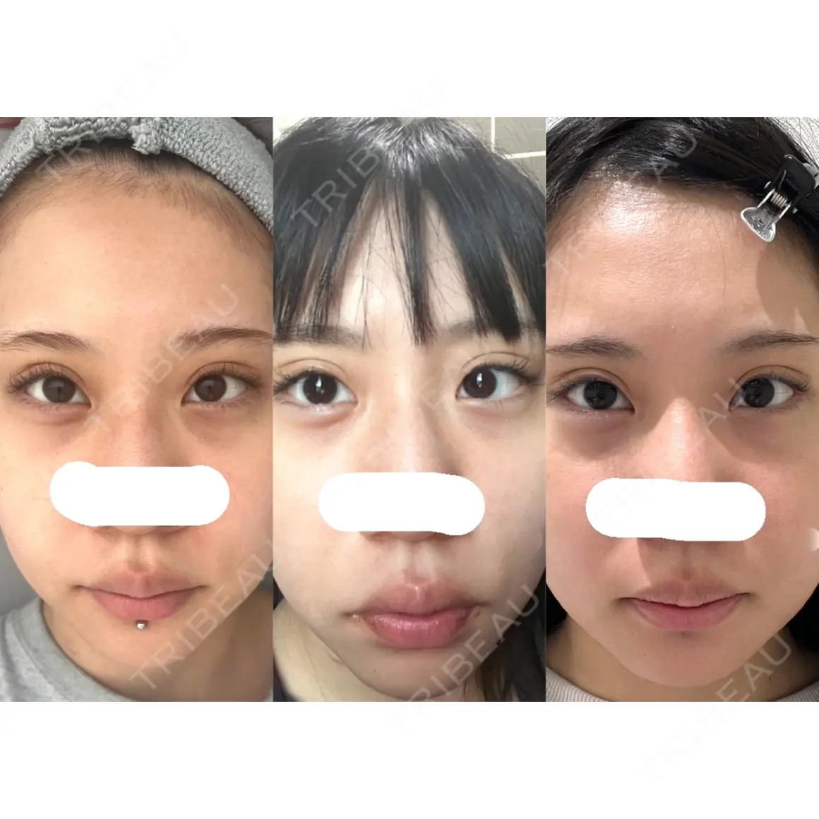 ヒアルロン酸注入（涙袋） / ヒアルロン酸注入（唇） / ボトックス（口角） 川越TAクリニックアソシエ AFTER