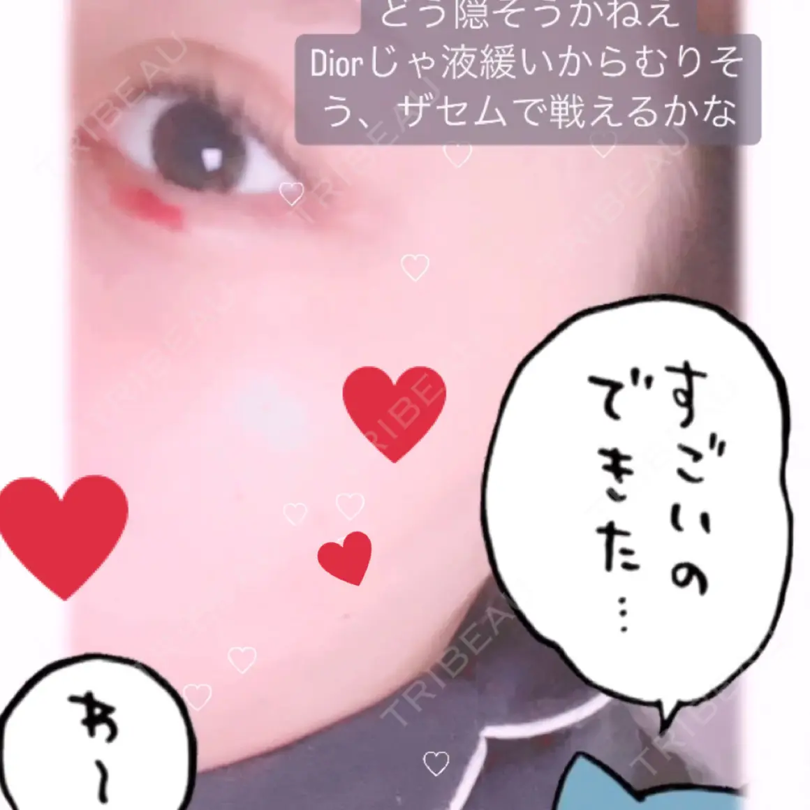ヒアルロン酸注入（涙袋） / ヒアルロン酸注入（唇） / ボトックス（口角） 川越TAクリニックアソシエ AFTER