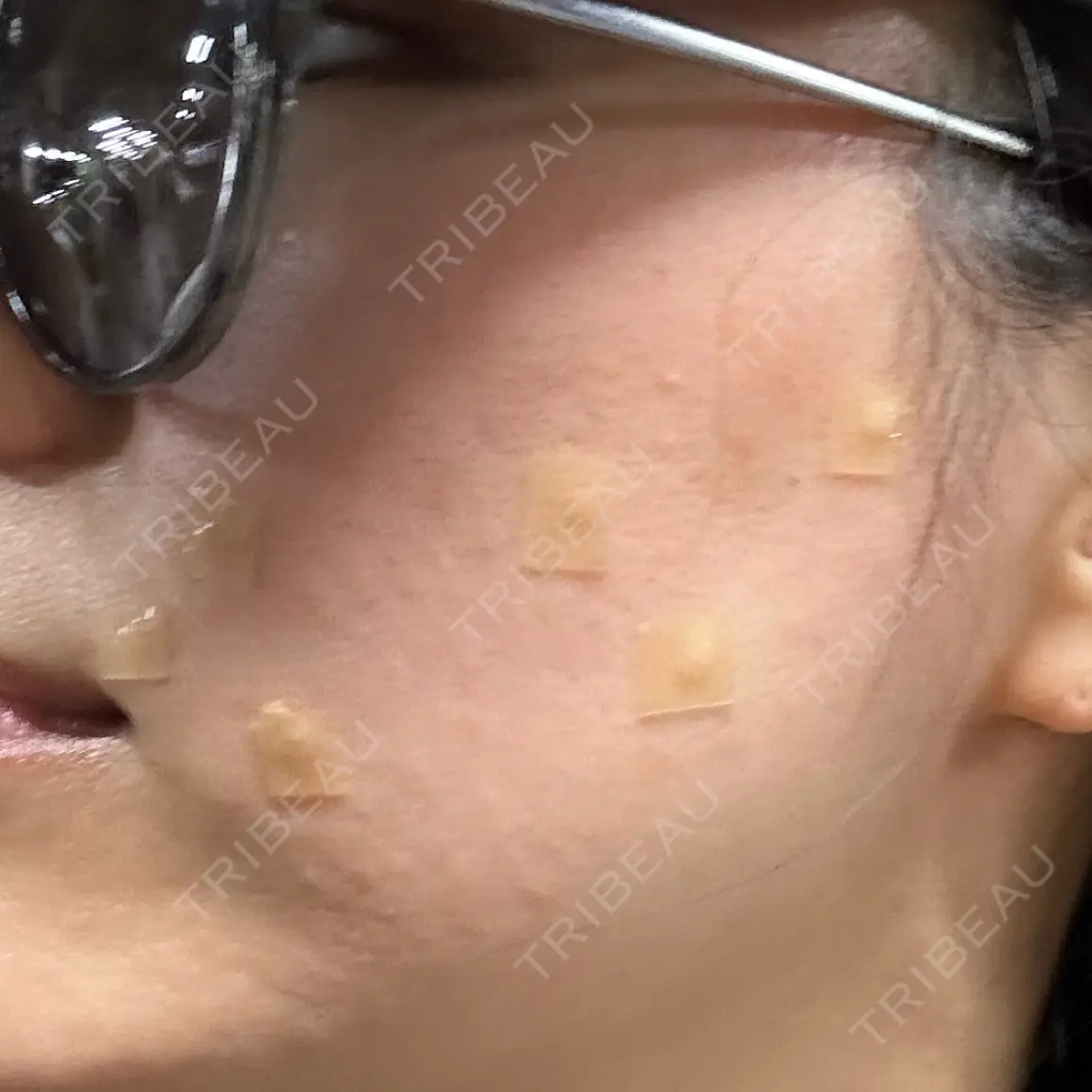 ほくろ・いぼ切除（肌） Jスキンクリニック 【J-SKIN clinic】 DAY 0