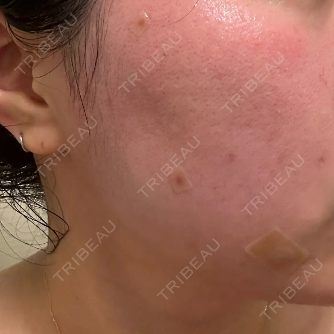ほくろ・いぼ切除（肌） Jスキンクリニック 【J-SKIN clinic】 AFTER