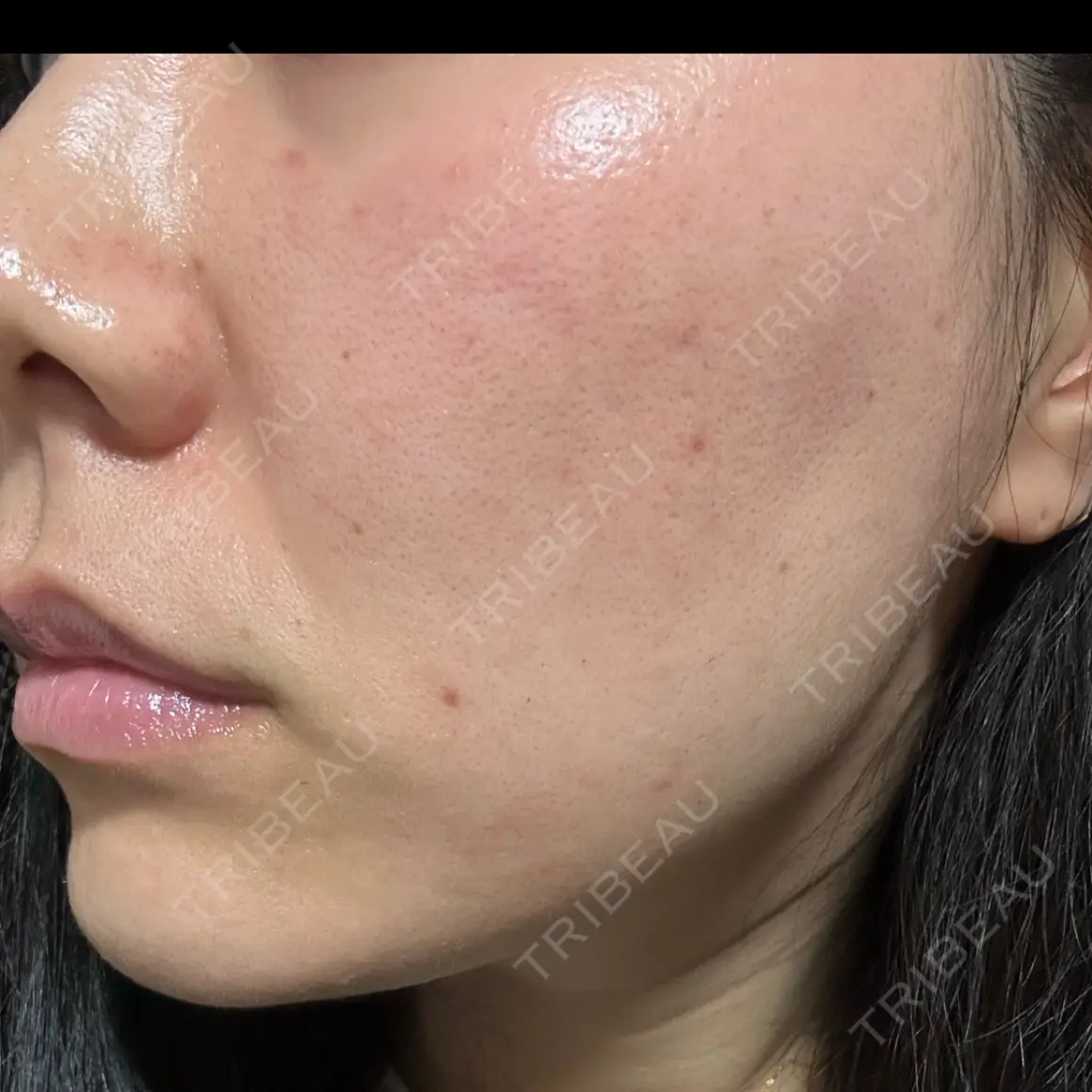 ほくろ・いぼ切除（肌） Jスキンクリニック 【J-SKIN clinic】 AFTER