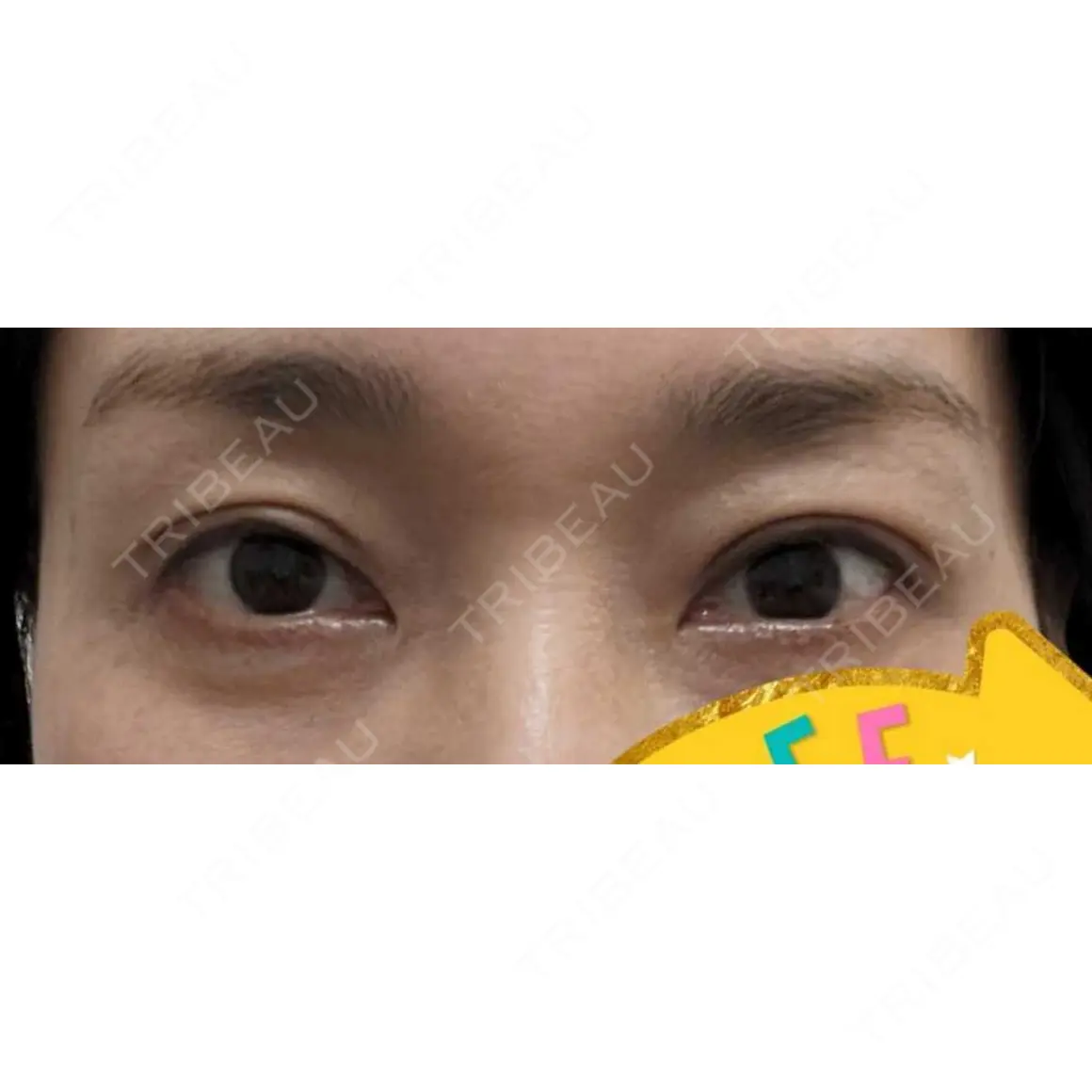 眼瞼下垂（切開） みやび形成外科 AFTER