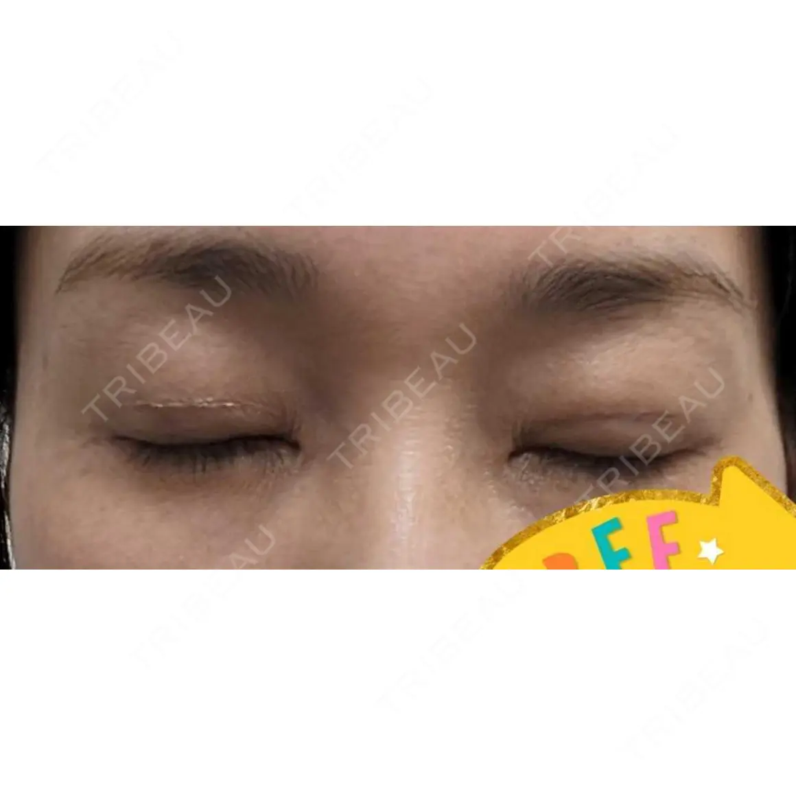 眼瞼下垂（切開） みやび形成外科 AFTER