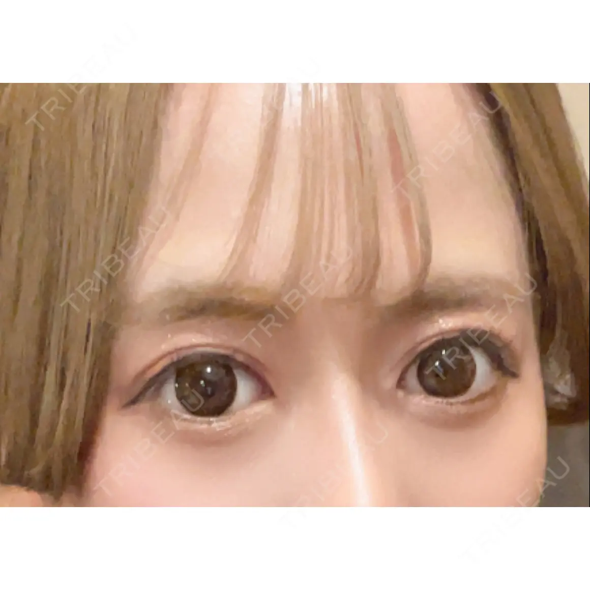 二重切開 高須クリニック 名古屋院 AFTER