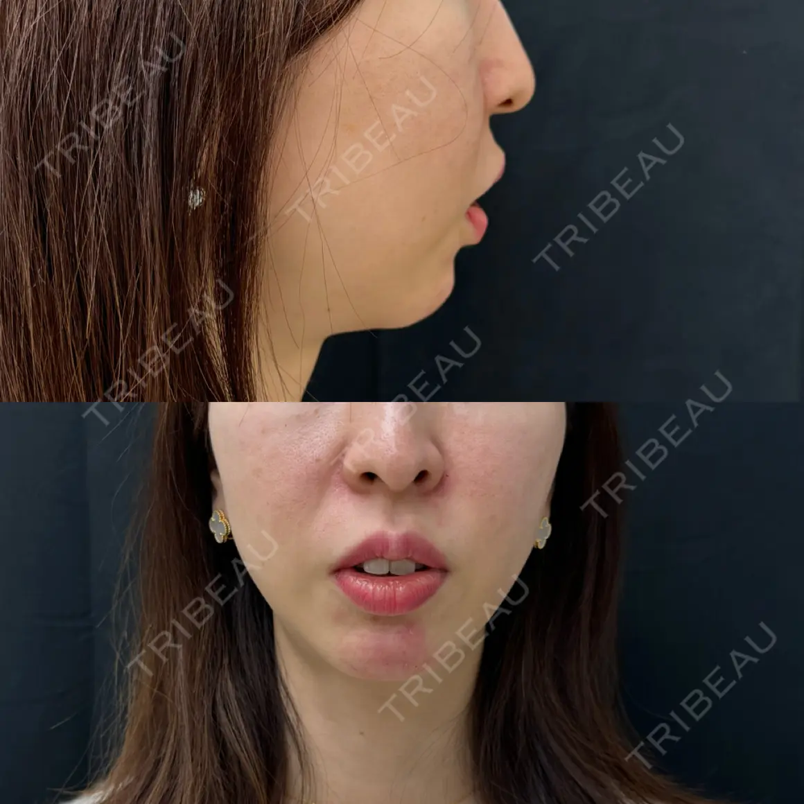 ヒアルロン酸注入（頬） Jスキンクリニック 【J-SKIN clinic】 DAY 0