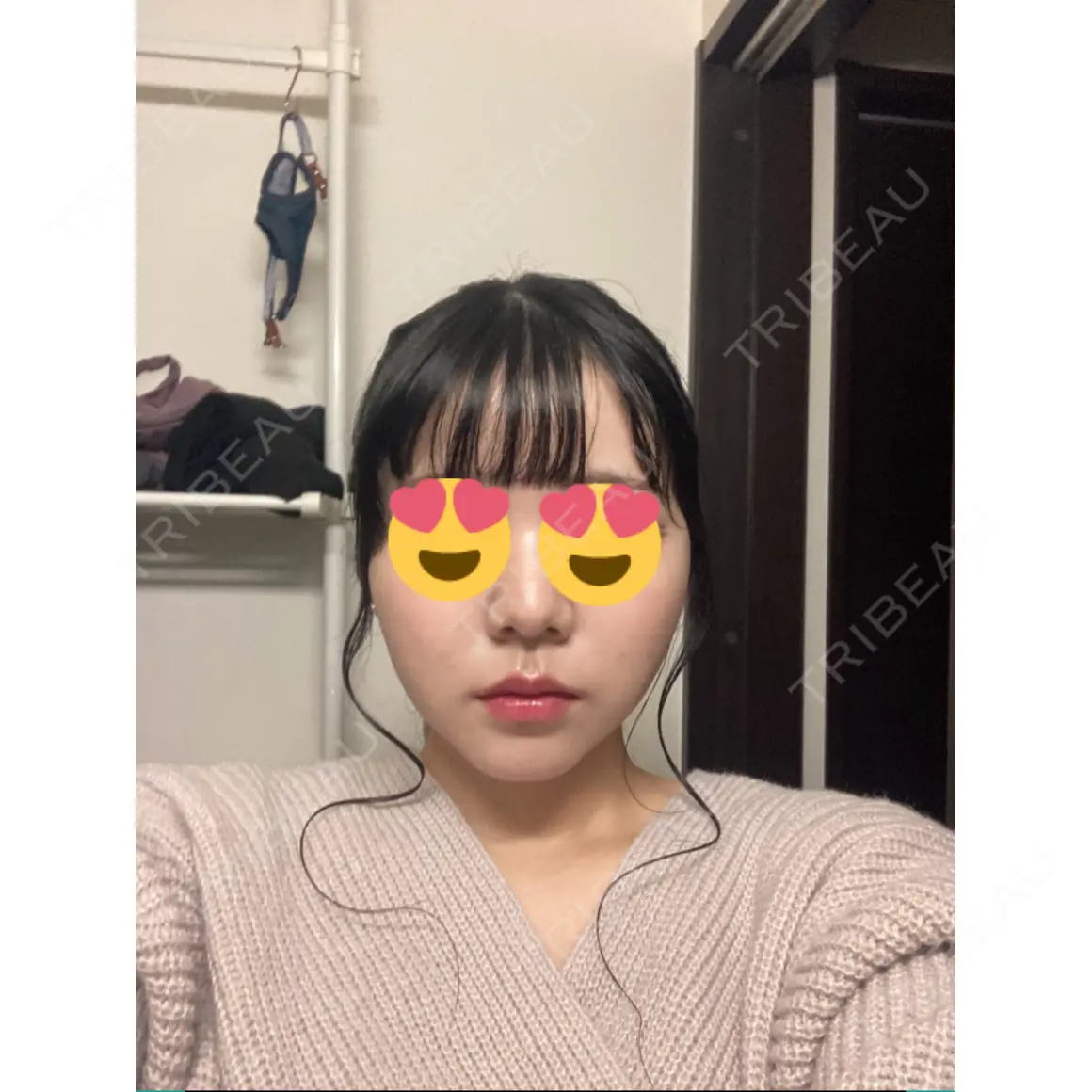 バッカルファット除去 / 脂肪吸引（顔） ルラ美容クリニック 名古屋本院 AFTER