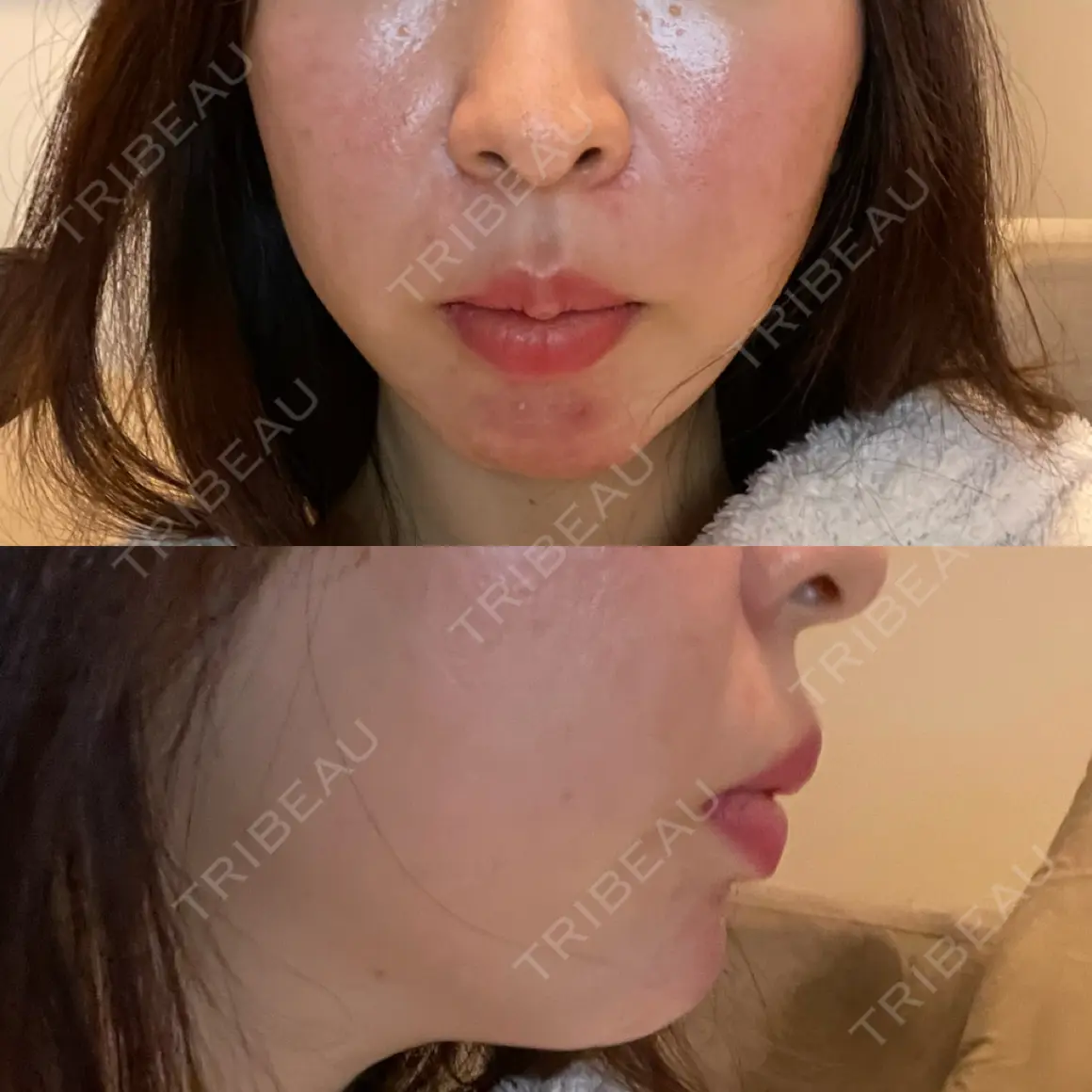 ヒアルロン酸注入（頬） Jスキンクリニック 【J-SKIN clinic】 AFTER
