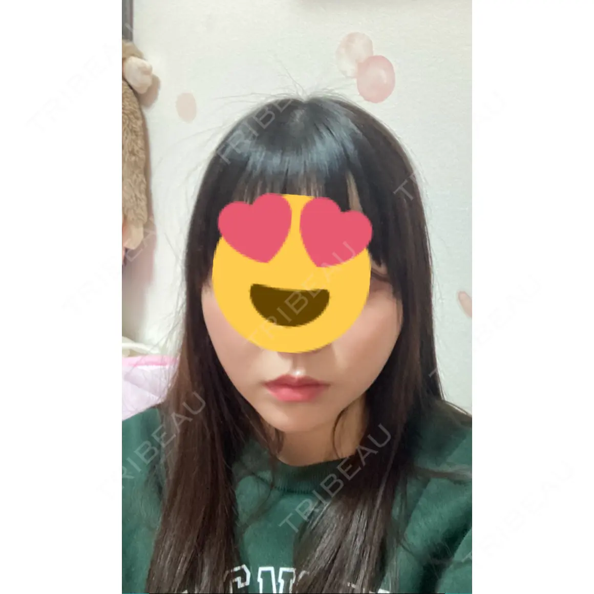 バッカルファット除去 / 脂肪吸引（顔） ルラ美容クリニック 名古屋本院 AFTER