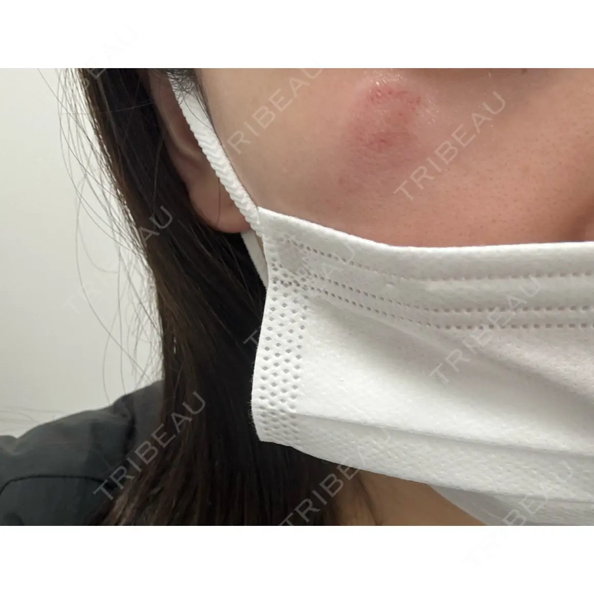 シミ取りレーザー / エレクトロポレーション NI MEDICAL CLINIC DAY 0