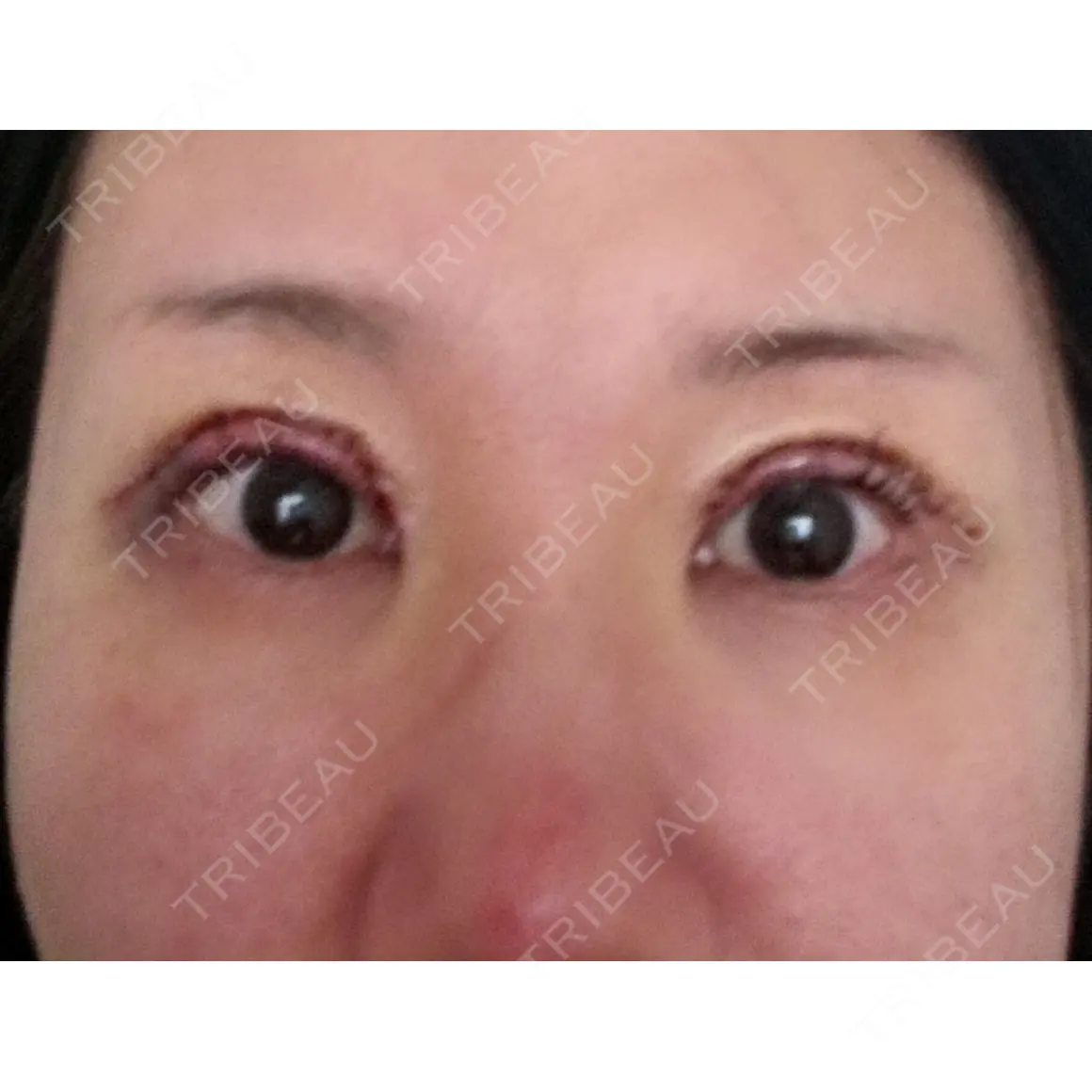 二重切開 / 眼瞼下垂（切開） / 上まぶたたるみ取り 四谷見附クリニック DAY 0