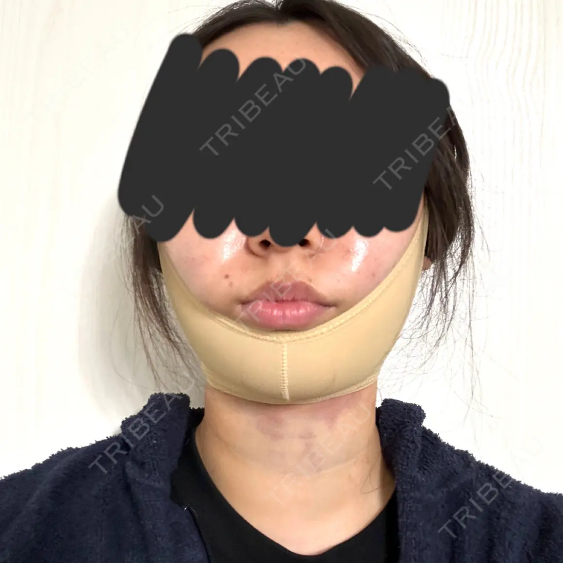 糸リフト / バッカルファット除去 / 脂肪吸引（顔） / メーラーファット除去 / 脂肪吸引注射（顔） SEA CLINIC（シークリニック） DAY 0