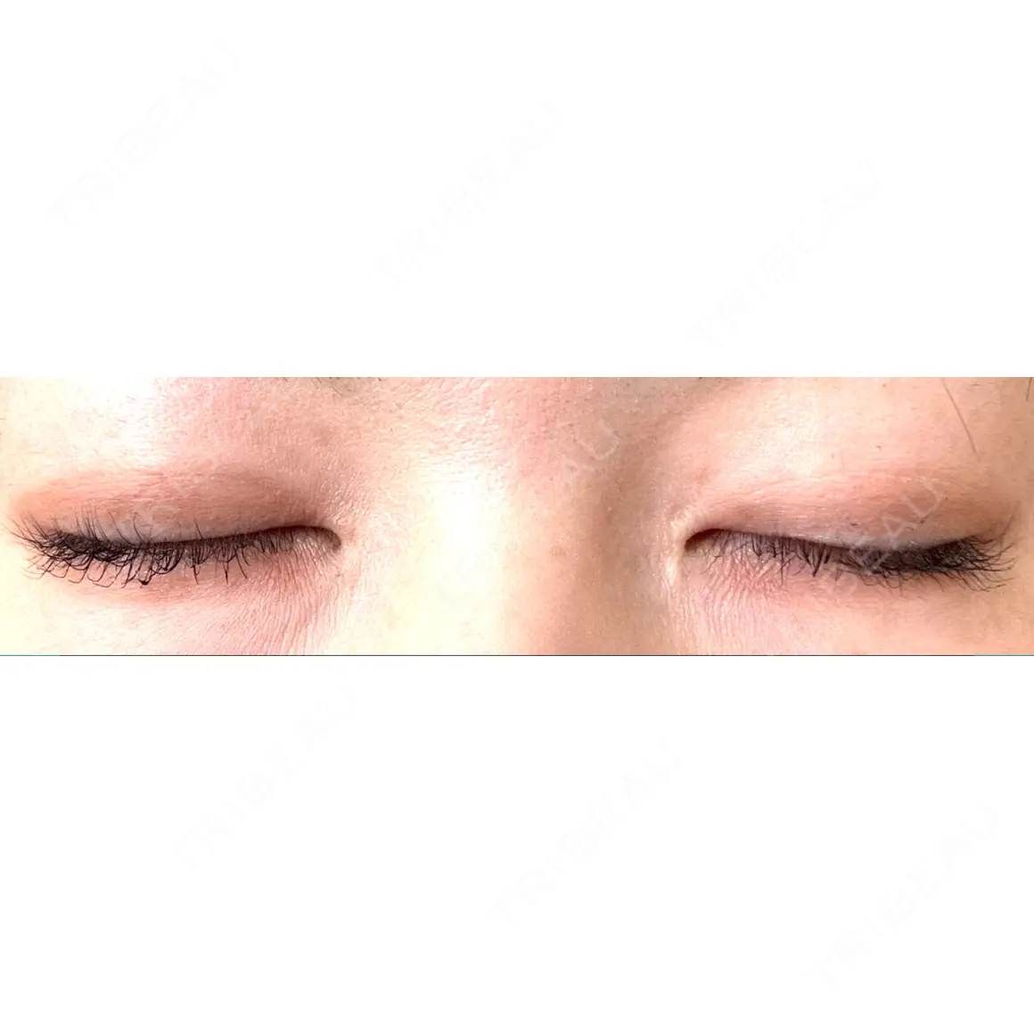 二重埋没 / 目頭切開 / 眼瞼下垂（切開） / 目元修正 / 自然癒着法 POP美容整形クリニック AFTER