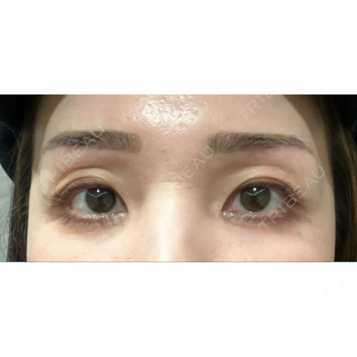 上まぶたの脂肪取り / 眉下切開 Otus Clinic 【オータスクリニック】 AFTER