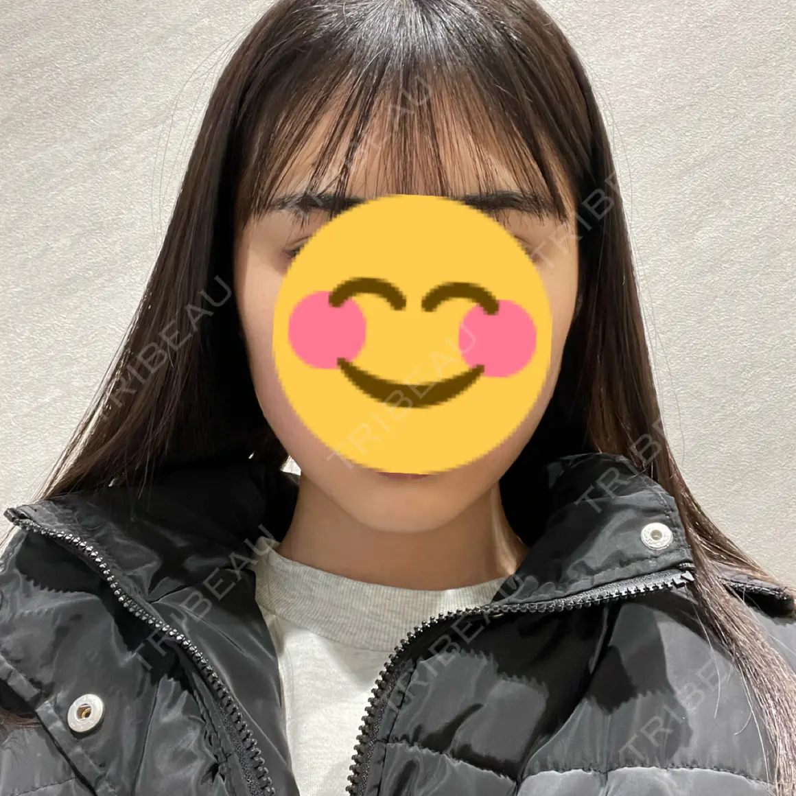 脂肪吸引注射（顔） ziz CLINIC DAY 0