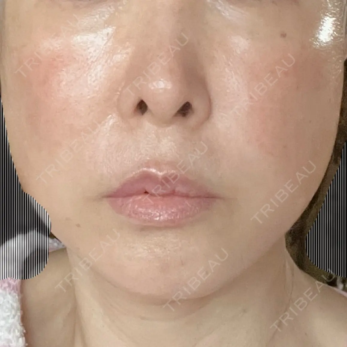 切開リフト かわた美容クリニック DAY 7