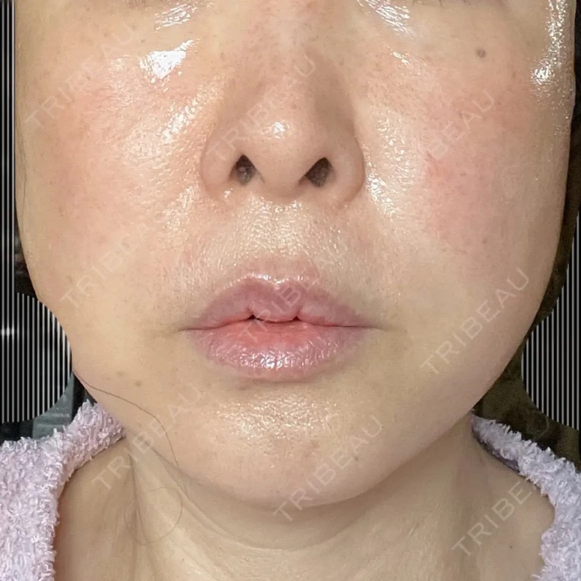 切開リフト かわた美容クリニック AFTER